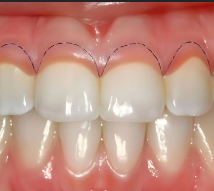 Gingivectomy